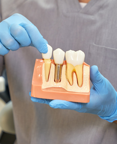 Implantología dental Aspe