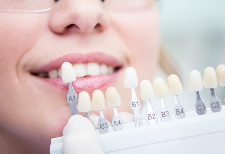 Blanqueamiento dental en Aspe