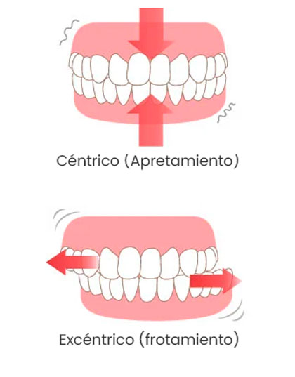 Bruxismo Aspe